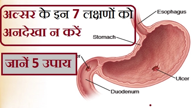 पेट में अल्सर के 7 लक्षण - Ulcer In Stomach