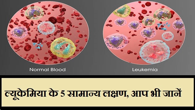 ल्यूकेमिया के 5 सामान्य लक्षण, आप भी जानें - Leukemia  Symptoms In Hindi