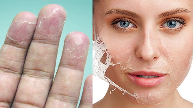 सर्दी में निकलती त्वचा से बचाव के 5 उपाय