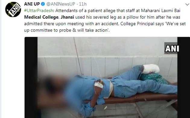 शर्मनाक, मरीज के कटे पैर को बना दिया तकिया - leg of patient used as pillow in jhansi medical college