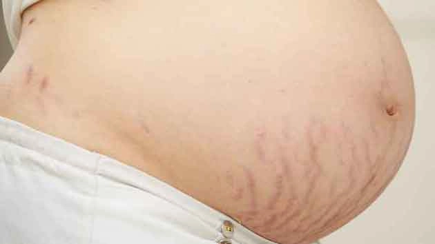 गर्भावस्था में स्ट्रेच मार्क्स से बचने के 4 आसान तरीके... - avoiding stretch marks