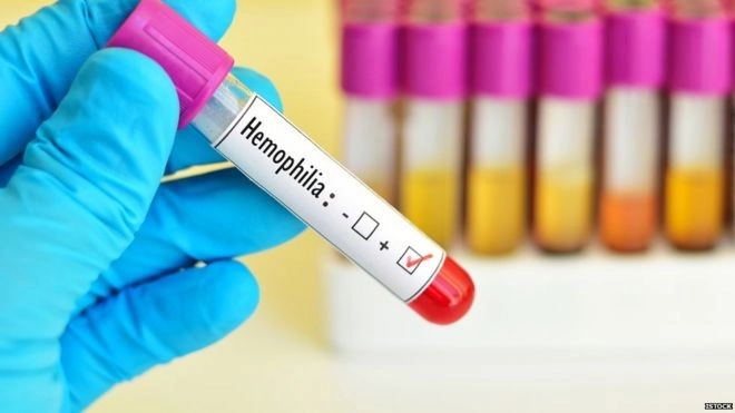 हीमोफीलिया: जब शरीर से ख़ून निकलना बंद नहीं होता - haemophilia