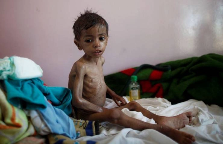 यमन भीषण अकाल की चपेट में, संयुक्त राष्ट्र ने की दानदाताओं से मदद की अपील