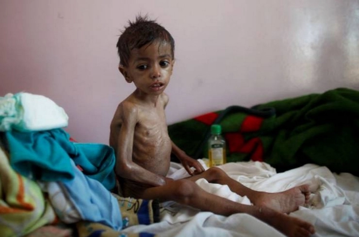 यमन में भयंकर अकाल का खतरा, संयुक्त राष्ट्र ने दी चेतावनी