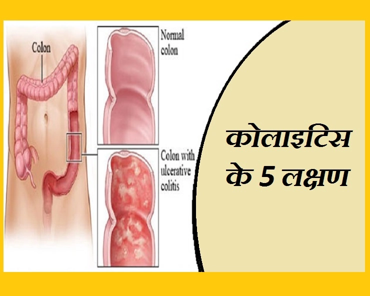 इन 5 लक्षणों से जानिए कि कहीं आप कोलाइटिस के मरीज तो नहीं - Colitis Symptoms In Hindi