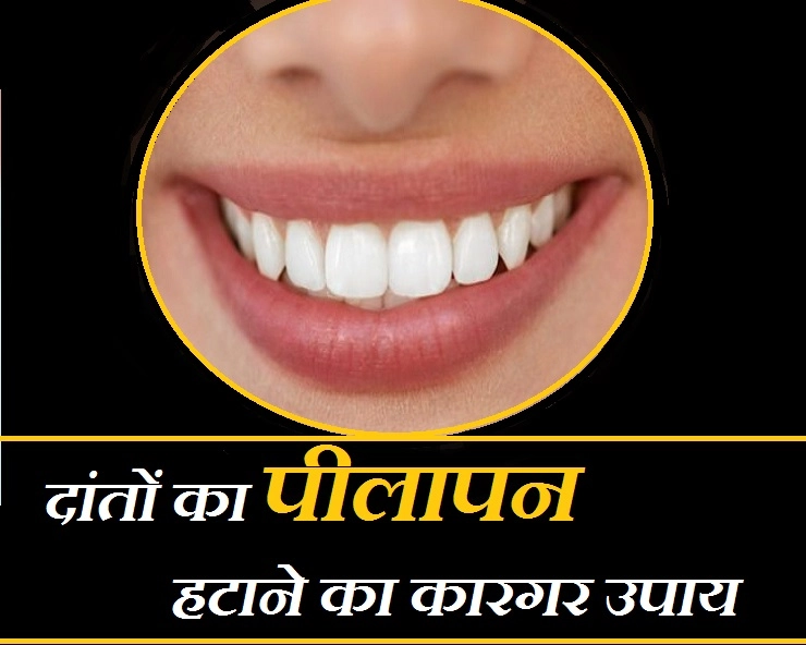 दांतों का पीलापन हटाएगा सिर्फ 1 जादुई उपाय, जानिए कैसे अपनाएं... - Tips For White Teeth
