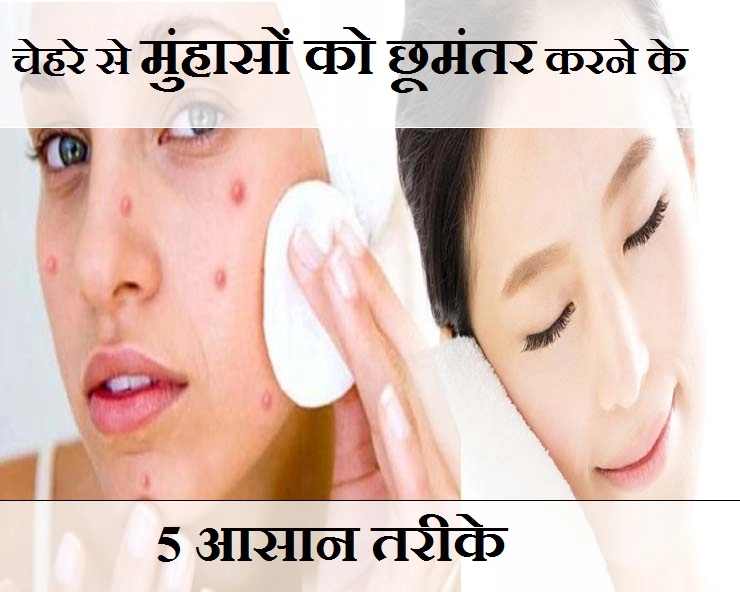 चेहरे पर बार-बार मुंहासे आने से परेशान है? तो उनसे पीछा छुड़ाने के 5 तरीके आजमाएं - 5 ways to conceal acne from the face