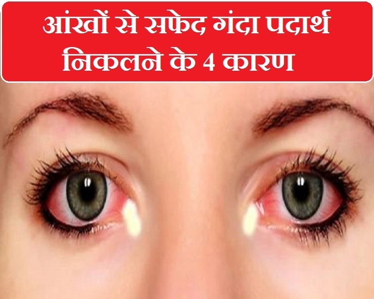 क्या आप जानते हैं किन 4 परिस्थितियों में निकलता है आंखों से सफेद गंदा पदार्थ? - 4 reasons of white discharge from eyes