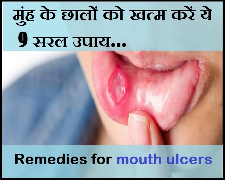 मुंह में छालों की समस्या रहती है? तो इन उपायों से राहत पाएं - 9 simple solutions for mouth ulcers