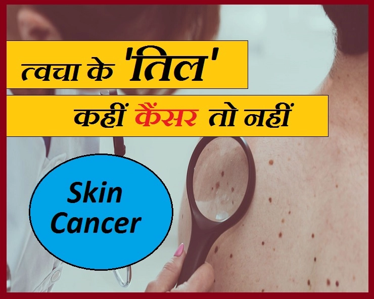 त्वचा पर तेजी से बढ़ रहे हैं तिल? तो यह हो सकता है कैंसर का संकेत - Moles Causes Skin Cancer