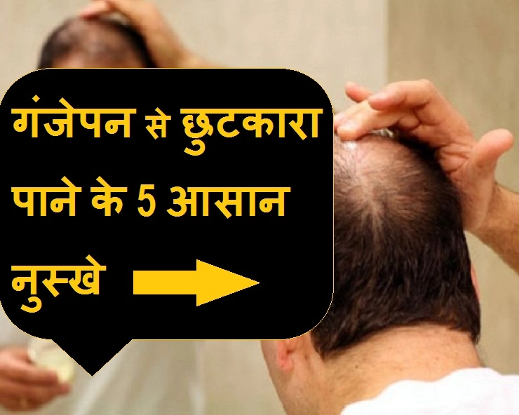 बिना किसी नुकसान इन 5 नुस्खों से पाएं गंजेपन से छुटकारा - effective remedy for baldness