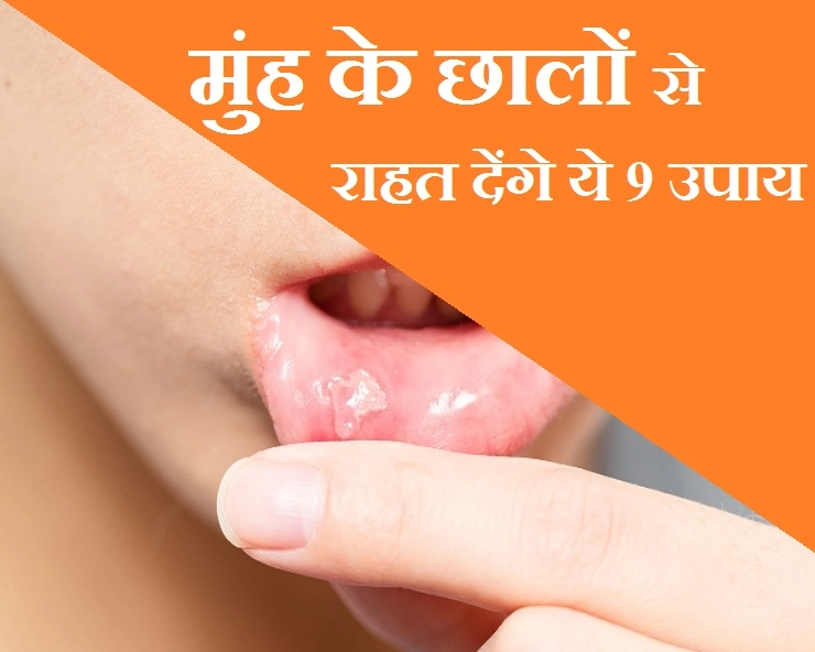 मुंह के छालों से परेशान हैं? तो अपनाएं ये आसान से घरेलू उपाय - 9 Home remedies for Mouth Ulcers