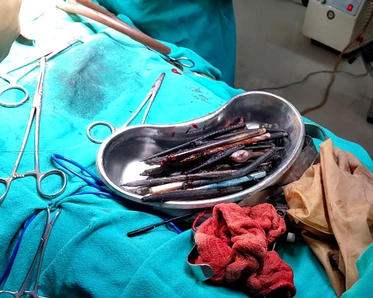 ऑपरेशन के बाद युवक के पेट से निकला कबाड़, डॉक्टर भी चौंके - After the operation turned out to be junk in the stomach