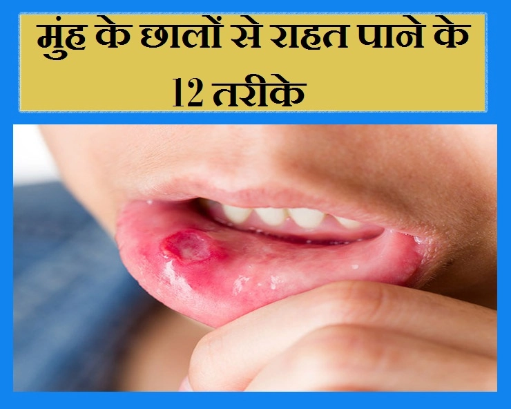 नहीं सहा जाता मुंह के छालों का दर्द, तो राहत पाने के 12 तरीके जान लीजिए - 12 Remedies for Mouth Ulcers