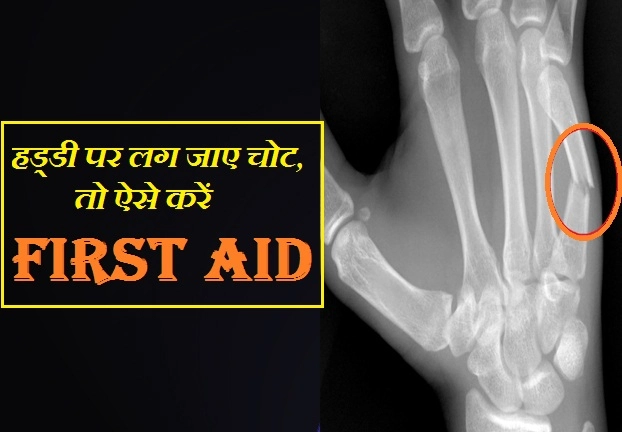 जब हड्डी पर लग जाए चोट, तो सबसे पहले करें ये फर्स्ट एड - first aid for bone injury
