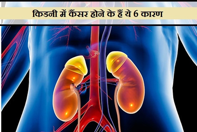 6 reasons of kidney cancer l किडनी में कैंसर होने के ये 6 कारण आप भी जानिए - 6 reasons of kidney cancer