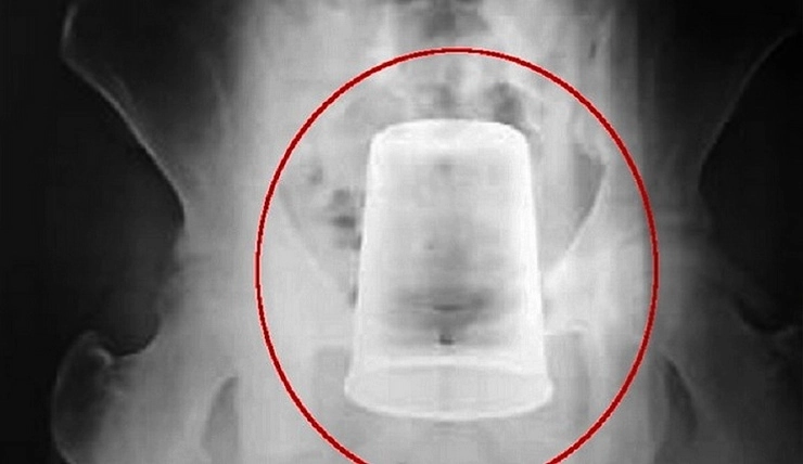ऑपरेशन कर युवक के पेट से निकाला स्‍टील का गिलास, दर्द से था परेशान... - A glass of steel removed from the stomach of a young man after an operation