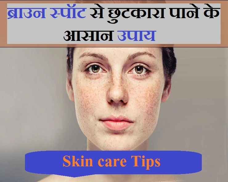 Skin Care Tips : इन 6 उपायों से करें ब्राउन स्पॉट को हल्का - 6 home remedy for brown spots of skin