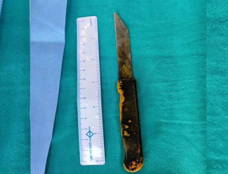 OMG! आदमी ने निगला 20 सेंटीमीटर लंबा चाकू, डॉक्टरों ने निकाला 3 घंटे की सर्जरी करके - AIIMS doctors remove 20 cm long knife from liver