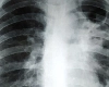 World tuberculosis day- ટીબી(Tuberculosis) શુ છે ? ટીબીના લક્ષણો અને સારવાર