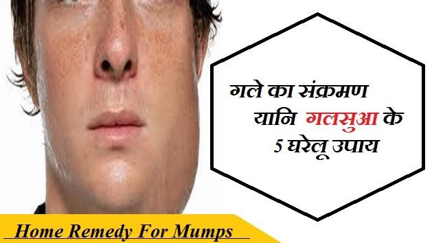 गले का संक्रमण यानी गलसुआ के 5 घरेलू उपाय - Mumps Disease