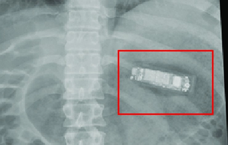 6 महीने से पेट दर्द से था परेशान, डॉक्टरों ने किया ऑपरेशन तो हो गए हैरान - Doctors extract mobile phone from mans stomach 6 months