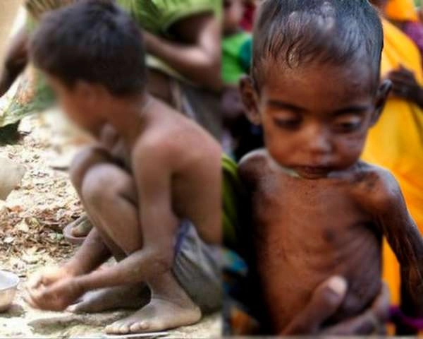 भारत में 33 लाख से ज्यादा बच्चे कुपोषित, इनमें से आधे अत्यंत कुपोषित - Over 33 lakh children are malnourished in India