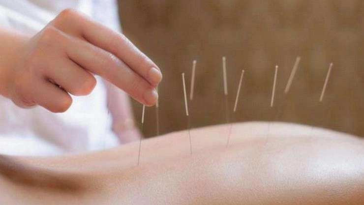 Acupuncture: कैसे काम करता है एक्यूपंक्चर? कैसे होता है दर्द निवारण?