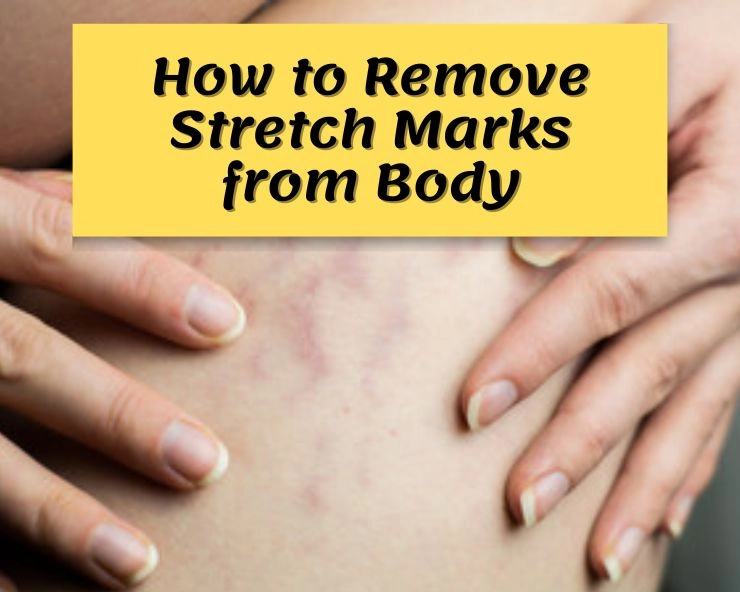 tips to remove stretch  marks