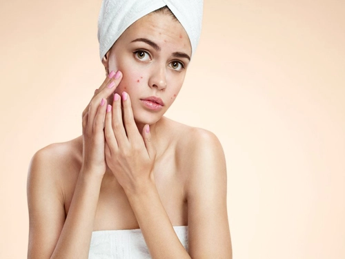 पिंपल्स का नहीं रहेगा नामोनिशान, त्वचा के लिए 8 घरेलू समाधान - Home remedies for pimples