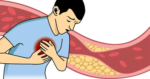 Cholesterol લેવલ વધતા શરીર આવા સંકેતો આપે છે, તેને અવગણવું જોખમી હોઈ શકે છે