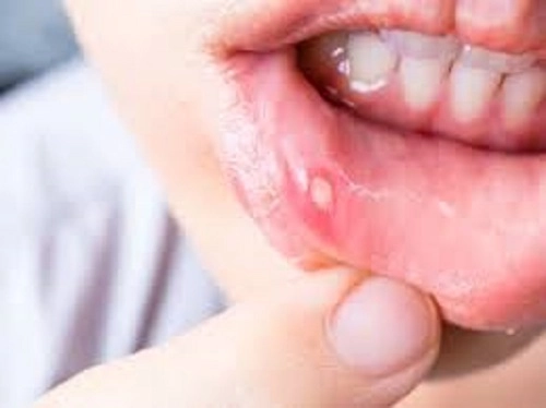 Mouth Ulcers - મોઢામાં ચાંદા થાય તો અપનાવો આ ઘરગથ્થુ ઉપચાર
