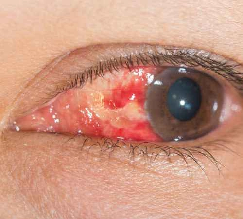 Eye Flu: पावसाळ्यात आय फ्लूचा धोका झपाट्याने वाढत आहे, लक्षणे आणि उपाय जाणून घ्या