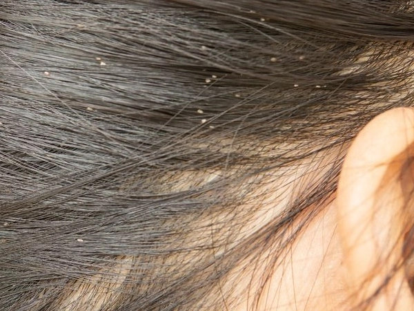 Hair Care Tips :  डोक्यात उवा असतील तर हे घरगुती उपाय करा