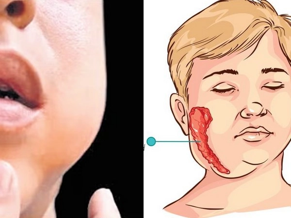 Mumps Outbreak,Mumps in kerala