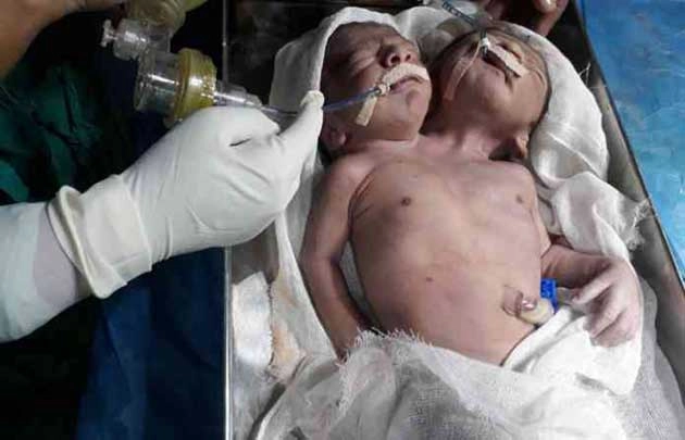 दोन शीर  असललेल्या बाळाचा मृत्यू