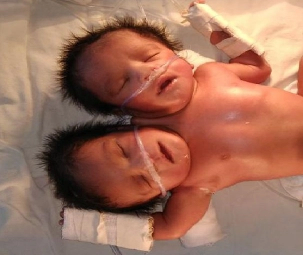 सोलापूर : दोन डोके असलेल्या विचित्र बालकाचा जन्म