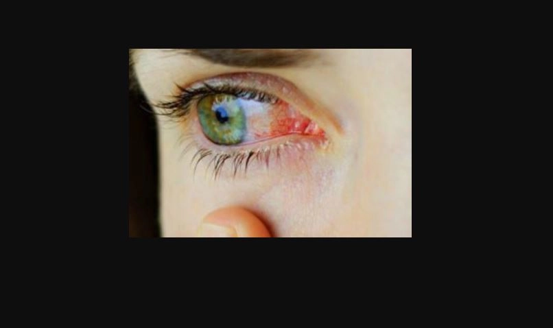 कोरोना: कोव्हिडमधून बरं झालेल्या काही रुग्णांमध्ये का वाढत आहेत डोळे आणि नाकाचे आजार?
