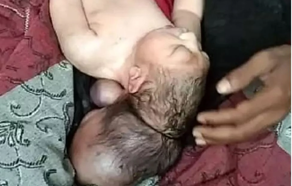 मैनपुरी येथे एका महिलेने 3-डोके असलेल्या मुलाला जन्म दिला, ते पाहण्यासाठी गर्दी जमली