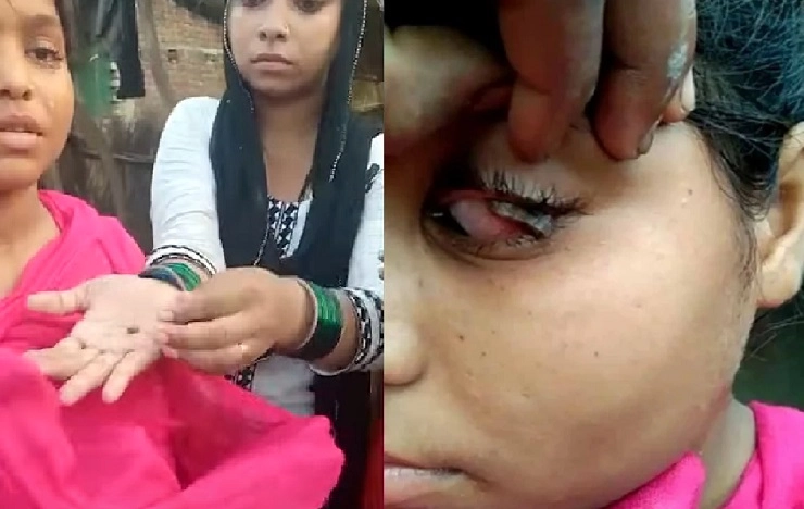 OMG! मुलीच्या डोळ्यातून टपकतात वाटाण्याच्या आकाराच्या खडे, डॉक्टरही हैराण; पाहा VIDEO