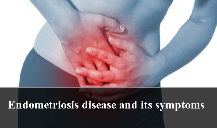 endometriosis-disease