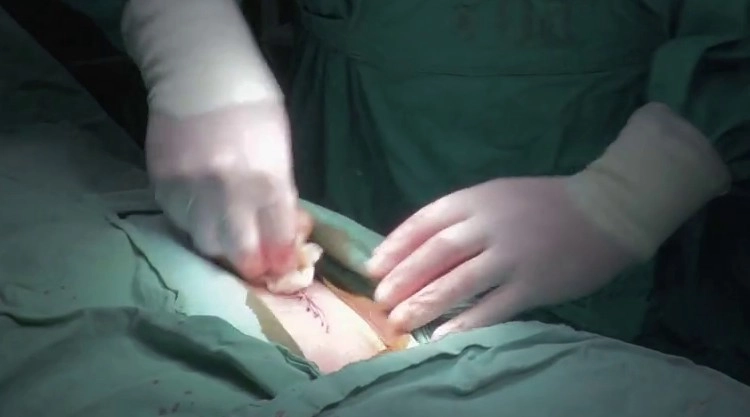 व्हिडीओ कॉलवर गर्भवतीची शस्त्रक्रिया, जुळ्या मुलांना जन्म दिल्यानंतर महिलेचा मृत्यू