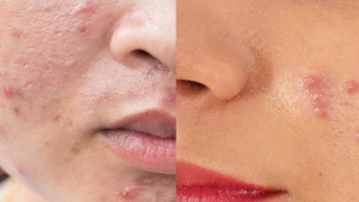 முகத்தில் பருக்கள் வருவதற்கான காரணங்களும் தீர்வுகளும் !!