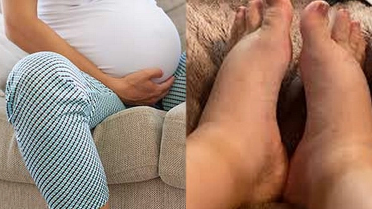 Pregnancy - Foot Swelling