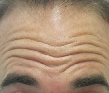 Forehead Folding