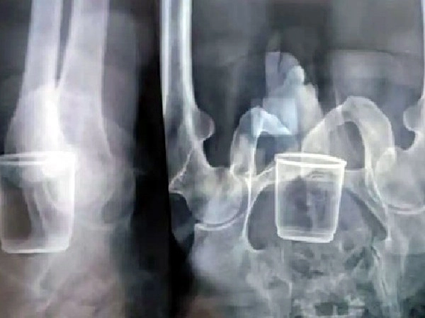 glass in stomach