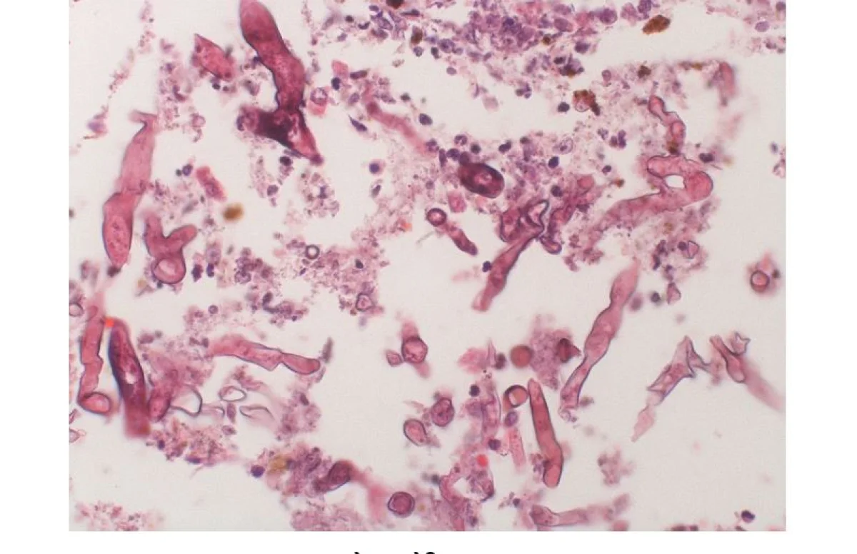 aspergillosis infection