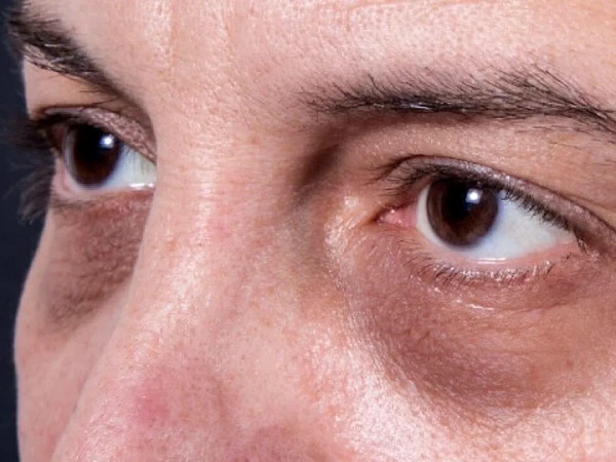 Follow these home remedies to remove dark circles DARK CIRCLE HOME REMEDIES IN MARATHI  MARATHI BEAUTY TIPS TO REMOVE DARK CICLES FOLLOW THESE HOME REMEDIES GADAD MANDALE KADHNYASATHI TIPS