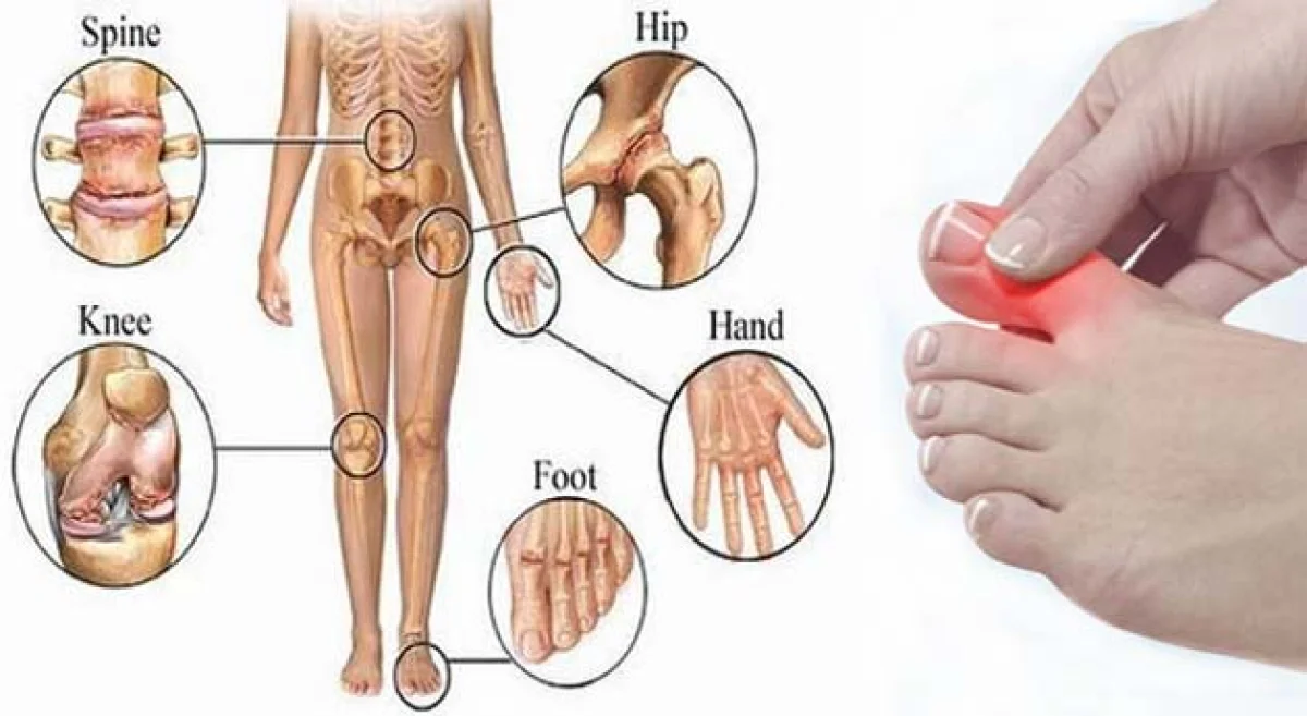 Home Remedies For Uric Acid