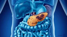 Pancreatic cancer: New drug extends lives but isn't a cure